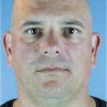 Kybella Before & After Patient #6268