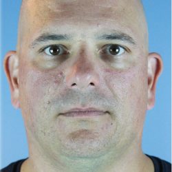 Kybella Before & After Patient #6268