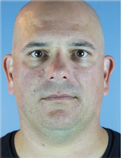 Kybella Before & After Patient #6268