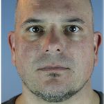 Kybella Before & After Patient #6268