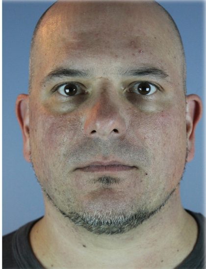 Kybella Before & After Patient #6268