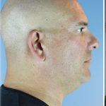 Kybella Before & After Patient #6268