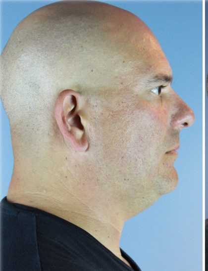 Kybella Before & After Patient #6268