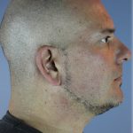 Kybella Before & After Patient #6268