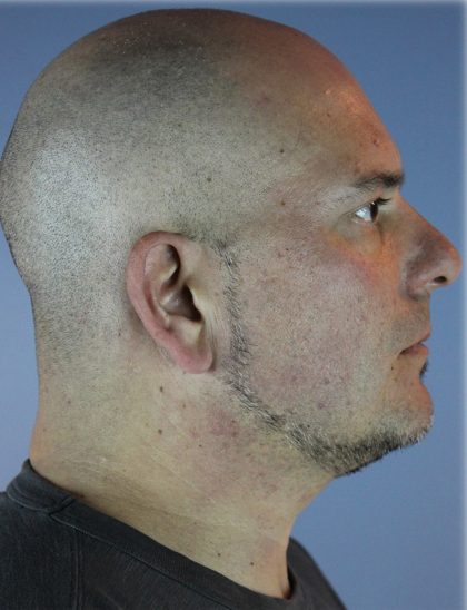 Kybella Before & After Patient #6268