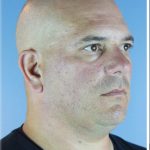Kybella Before & After Patient #6268