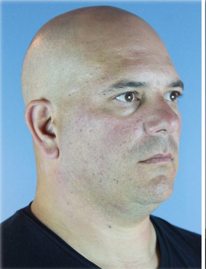 Kybella Before & After Patient #6268