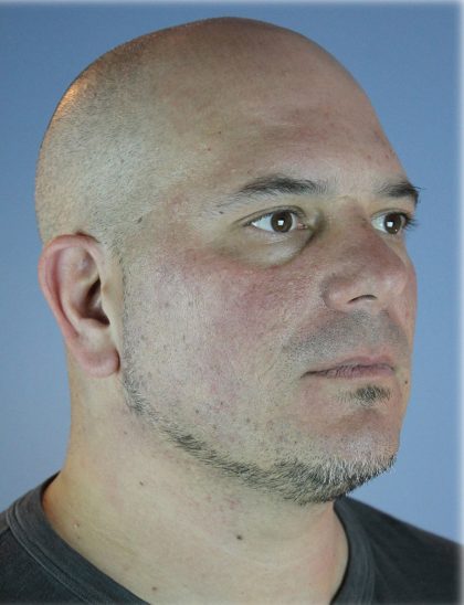 Kybella Before & After Patient #6268