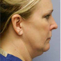 Neck Liposuction Before & After Patient #5334