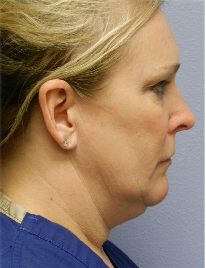 Neck Liposuction Before & After Patient #5334