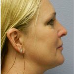 Neck Liposuction Before & After Patient #5334