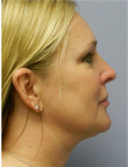 Neck Liposuction Before & After Patient #5334