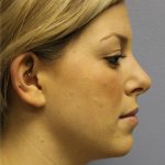 Neck Liposuction Before & After Patient #5348