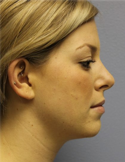 Neck Liposuction Before & After Patient #5348