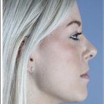 Neck Liposuction Before & After Patient #5348