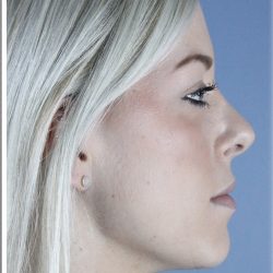 Neck Liposuction Before & After Patient #5348