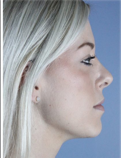 Neck Liposuction Before & After Patient #5348