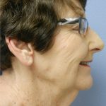 Neck Liposuction Before & After Patient #5358