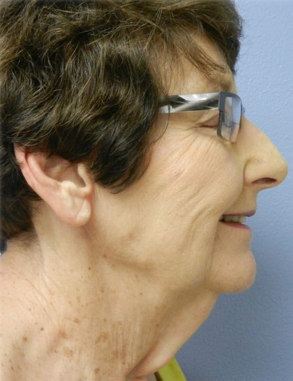 Neck Liposuction Before & After Patient #5358
