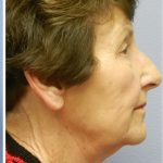 Neck Liposuction Before & After Patient #5358