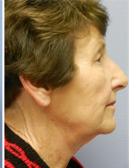 Neck Liposuction Before & After Patient #5358