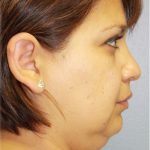 Neck Liposuction Before & After Patient #5363