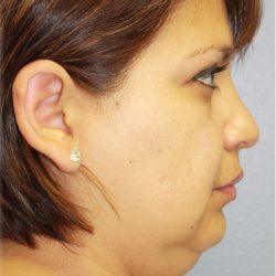 Neck Liposuction Before & After Patient #5363