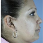 Neck Liposuction Before & After Patient #5363
