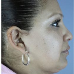 Neck Liposuction Before & After Patient #5363