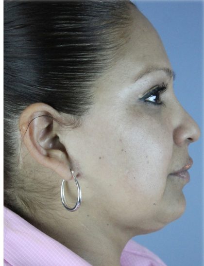 Neck Liposuction Before & After Patient #5363