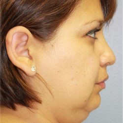 QuickLift Before & After Patient #5723