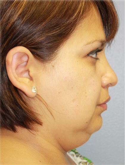 QuickLift Before & After Patient #5723