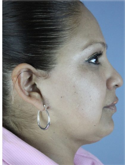 QuickLift Before & After Patient #5723