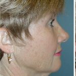 QuickLift Before & After Patient #5579