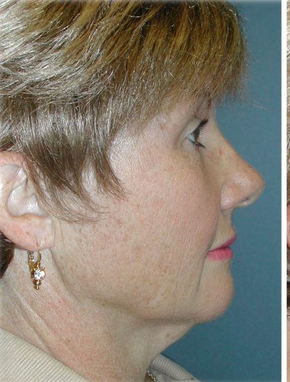 QuickLift Before & After Patient #5579