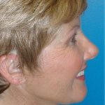 QuickLift Before & After Patient #5579