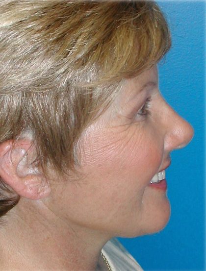 QuickLift Before & After Patient #5579