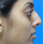 Rhinoplasty Before & After Patient #5818