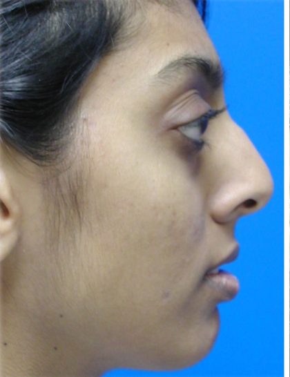 Rhinoplasty Before & After Patient #5818