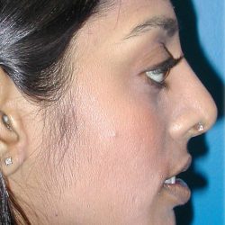 Rhinoplasty Before & After Patient #5818