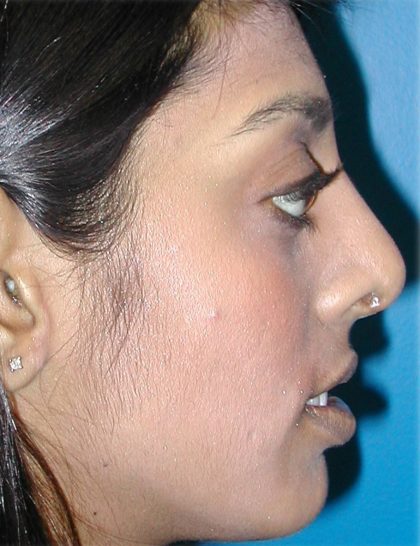 Rhinoplasty Before & After Patient #5818