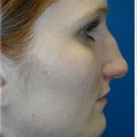 Rhinoplasty Before & After Patient #5825
