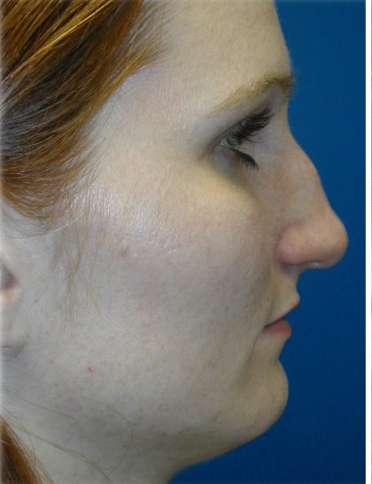 Rhinoplasty Before & After Patient #5825
