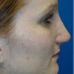 Rhinoplasty Before & After Patient #5825