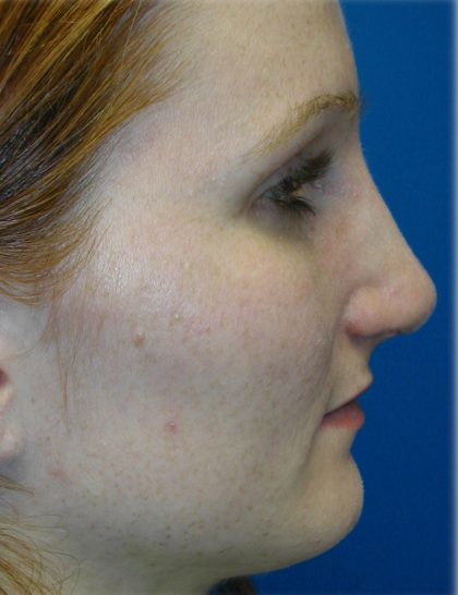 Rhinoplasty Before & After Patient #5825