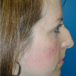 Rhinoplasty Before & After Patient #5839