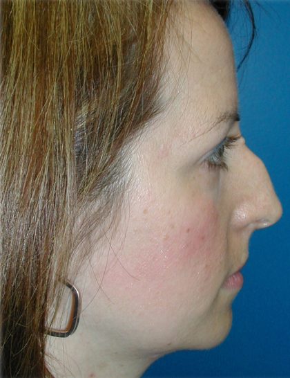 Rhinoplasty Before & After Patient #5839