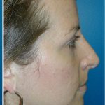 Rhinoplasty Before & After Patient #5839
