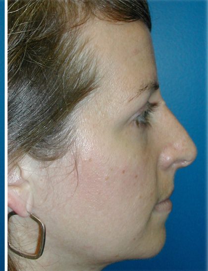 Rhinoplasty Before & After Patient #5839