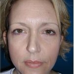 Rhinoplasty Before & After Patient #5848